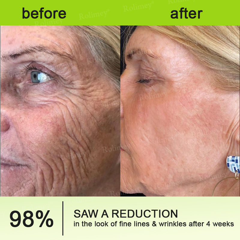 🧠👨‍⚕️Made and shipped from the USA 💫NATRAVOR® Botox & Vita-A Retinol Shot Wrinkle-Lift Tightening cream - Last Day Promotion 70% OFF